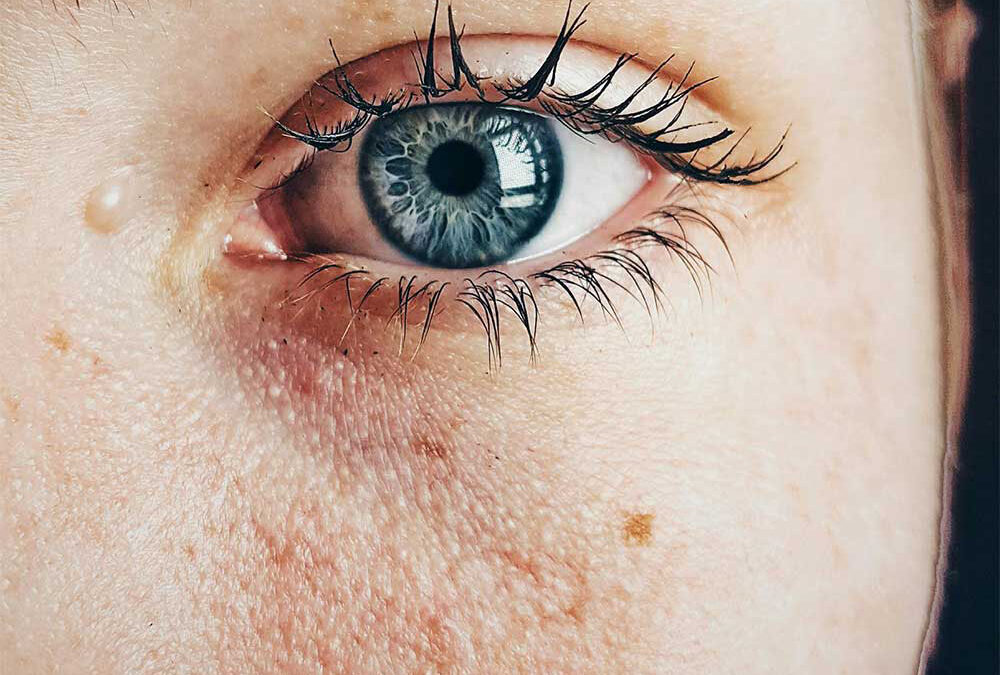 VERWIJDEREN RODE VAATJES EN PIGMENTVLEKKEN MET LASER