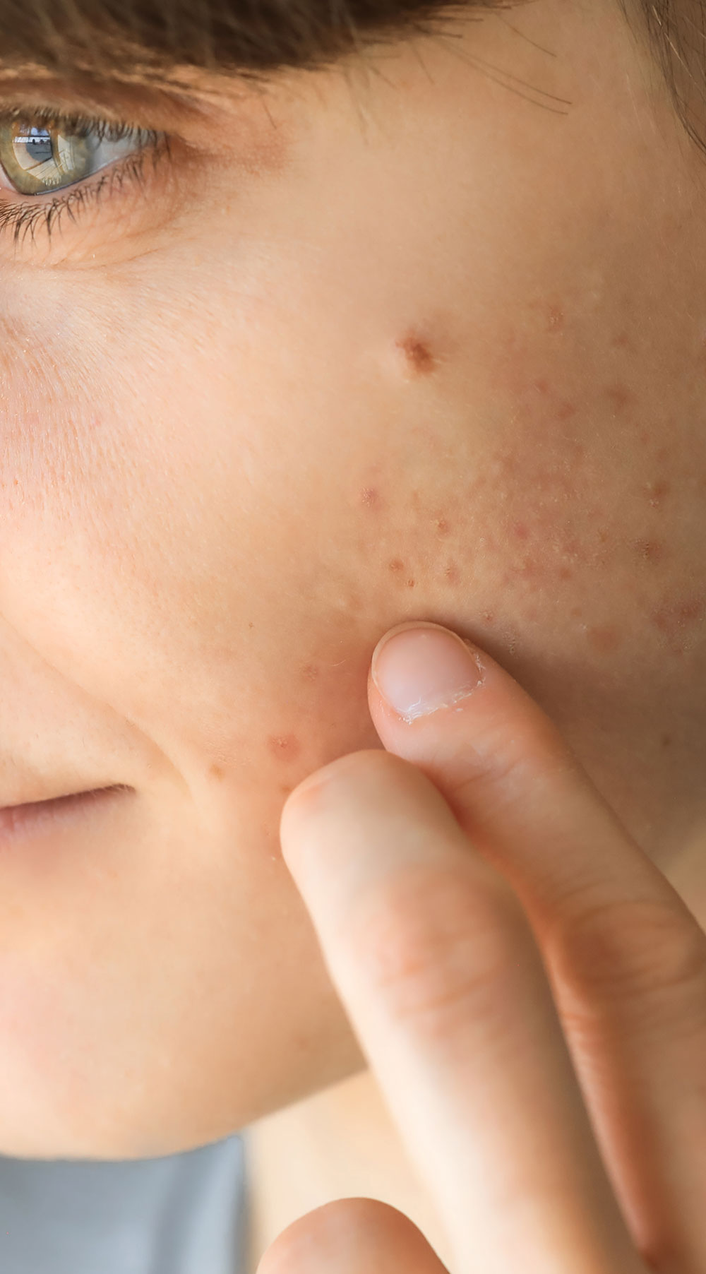 Huidbehandeling Acne Afbeelding van persoon met acne