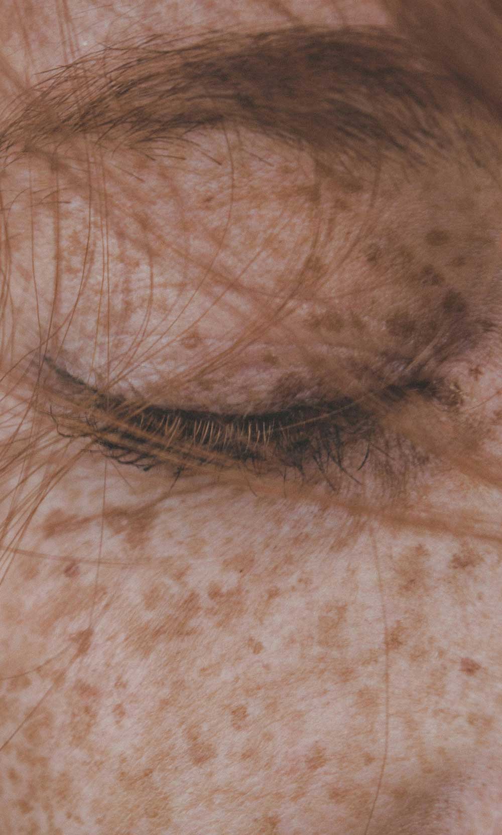 Afbeelding van huid met pigment en melasma